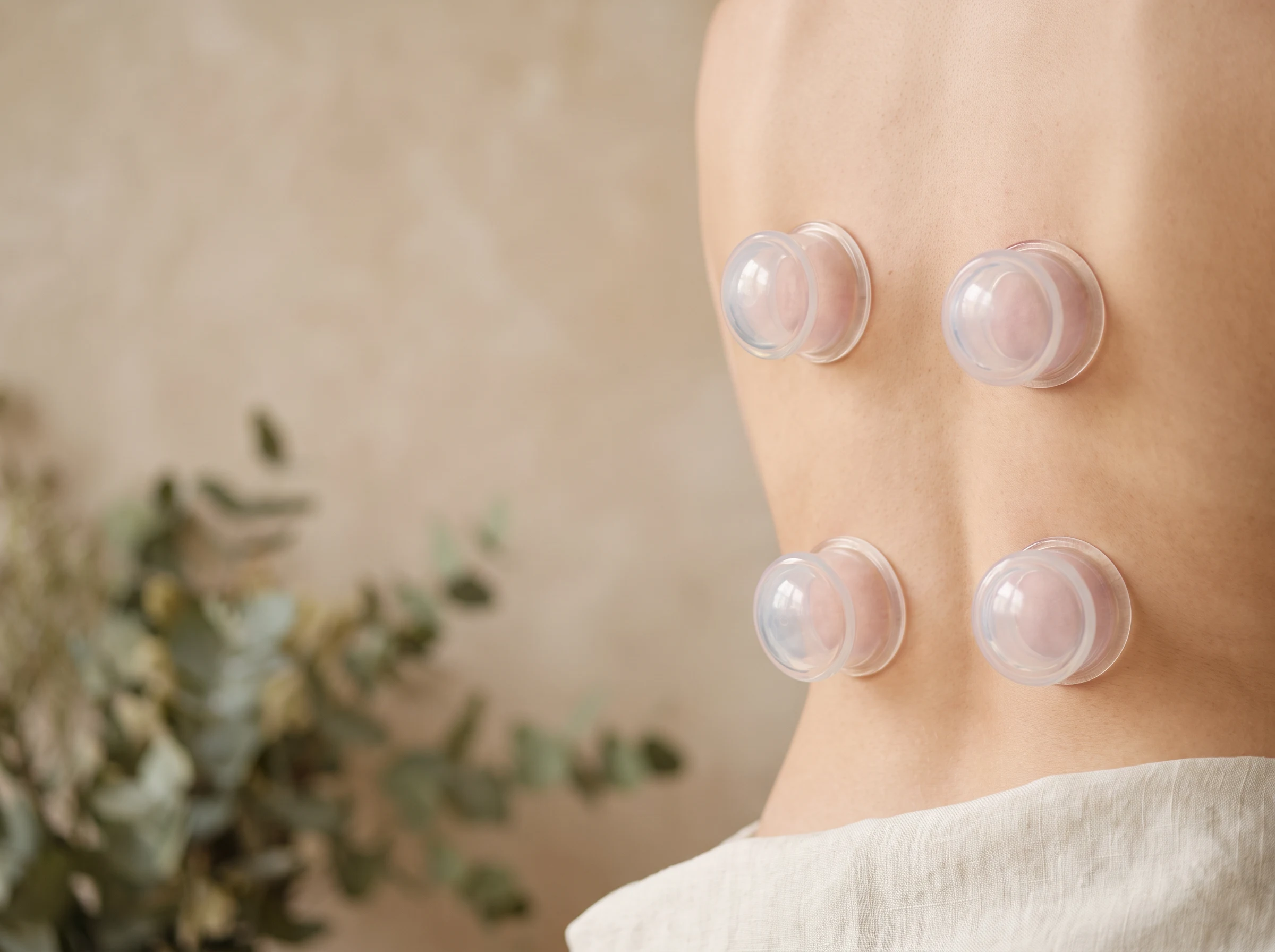 Four clear silicone cups placed during an anonymous upper-back cupping treatment.