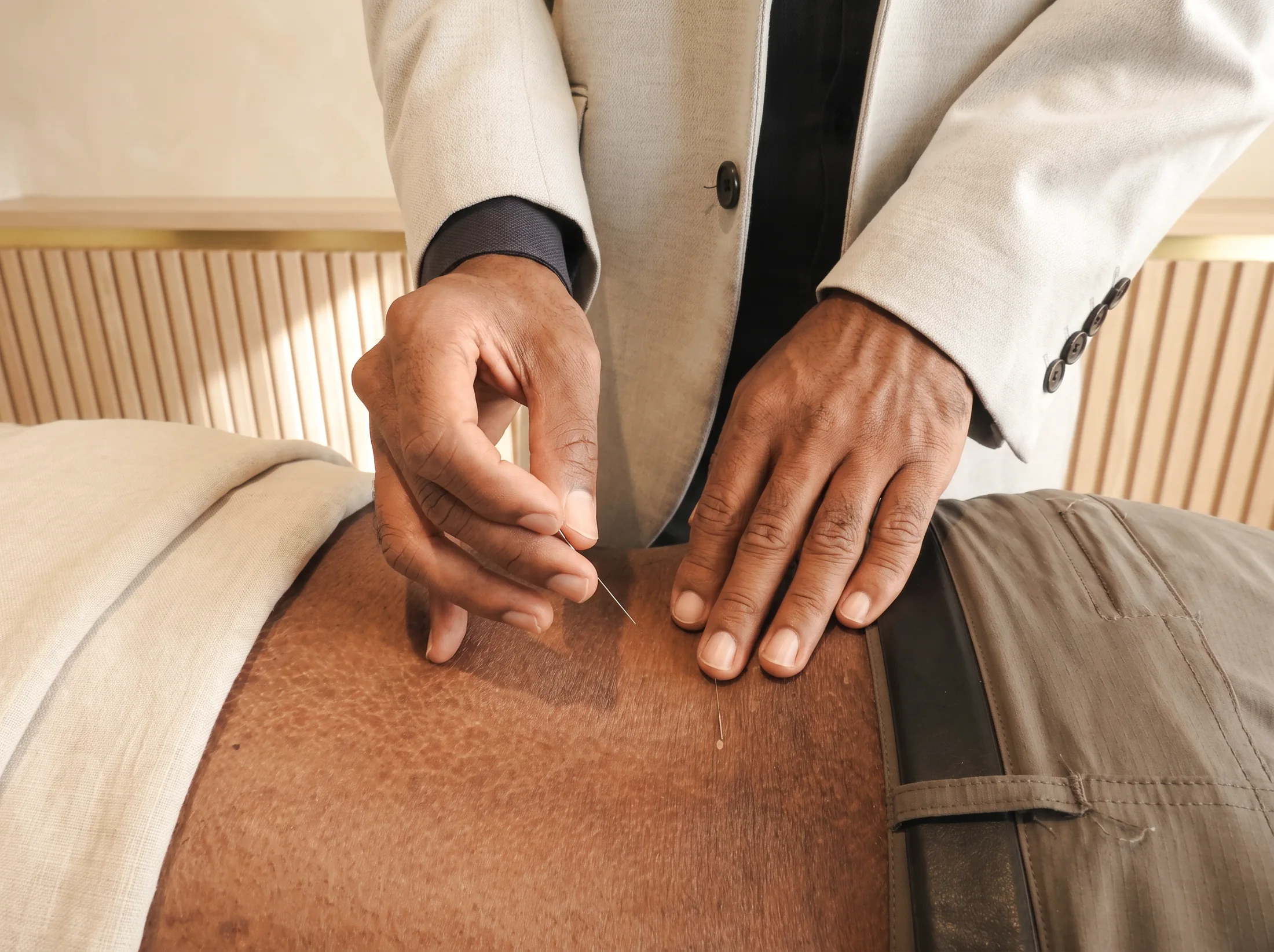 Acupuncture vs dry needling: what is the difference?